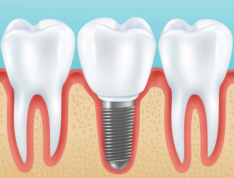 dental implant columbus