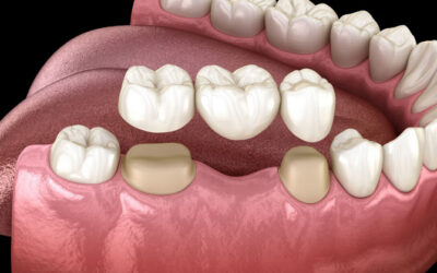 When and Why You Need a Dental Bridge