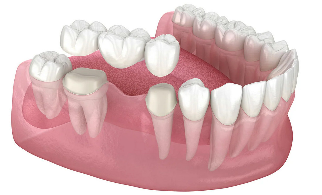 Dental Bridge Cost