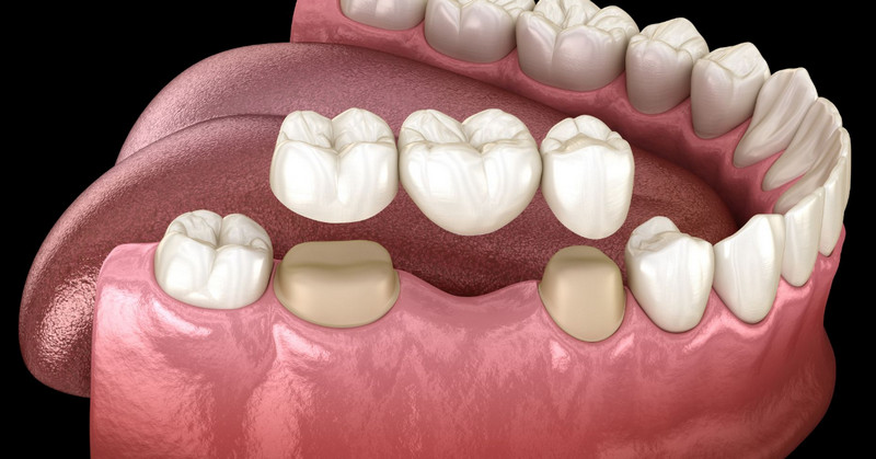 When and Why You Need a Dental Bridge