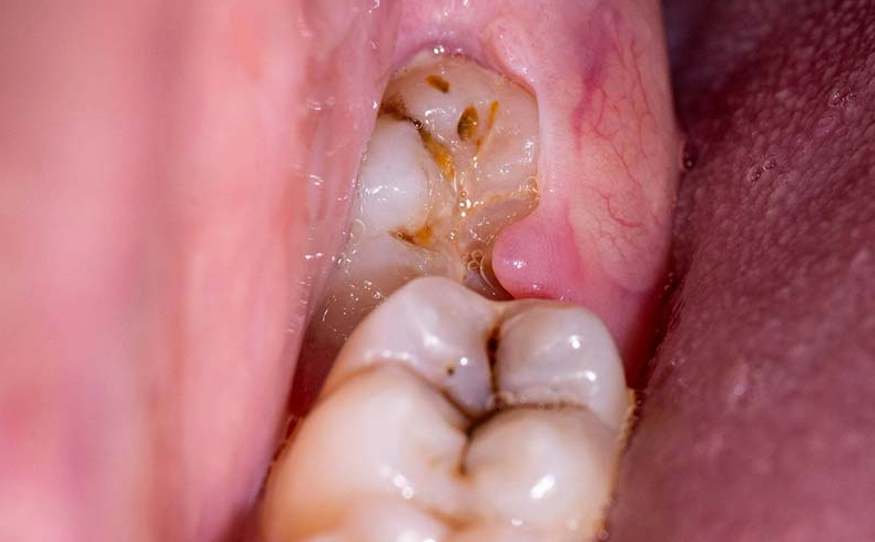 How do I know if my tooth is infected