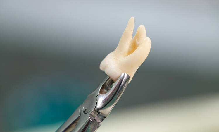 How Long Should It Take to Recover from Tooth Extraction?